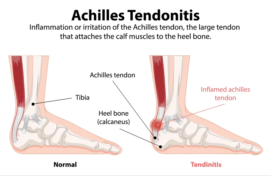 Medical illustration showing inflammation and thickening of the Achilles tendon at the back of the heel, indicating Achilles tendonitis
