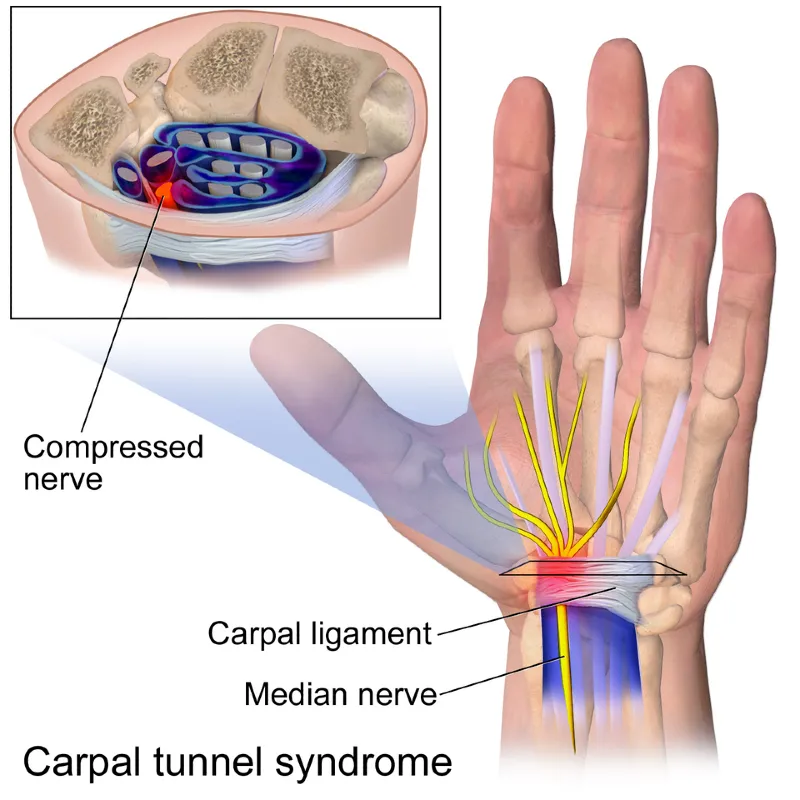 Anatomical illustration showing the carpal tunnel in the wrist, highlighting the median nerve and surrounding tendons. Sensory areas innervated by the median nerve in the hand are also indicated.