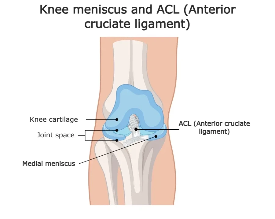 Anatomical illustration of the knee joint showing the anterior cruciate ligament (ACL) and both medial and lateral menisci positioned between the femur and tibia.