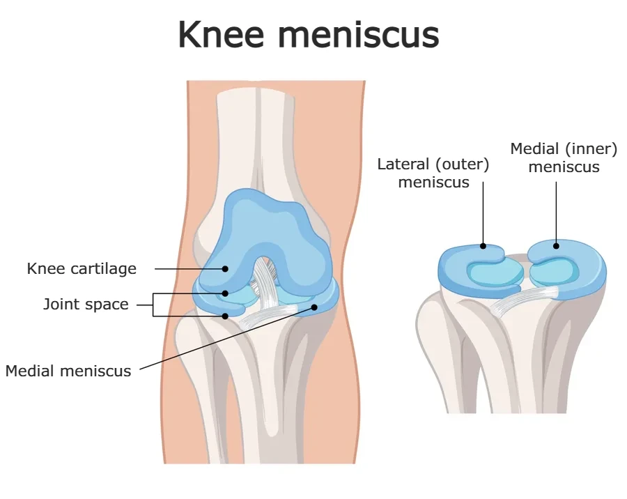 Detailed illustration of the knee meniscus showing medial and lateral menisci, their position in the knee joint, and structure