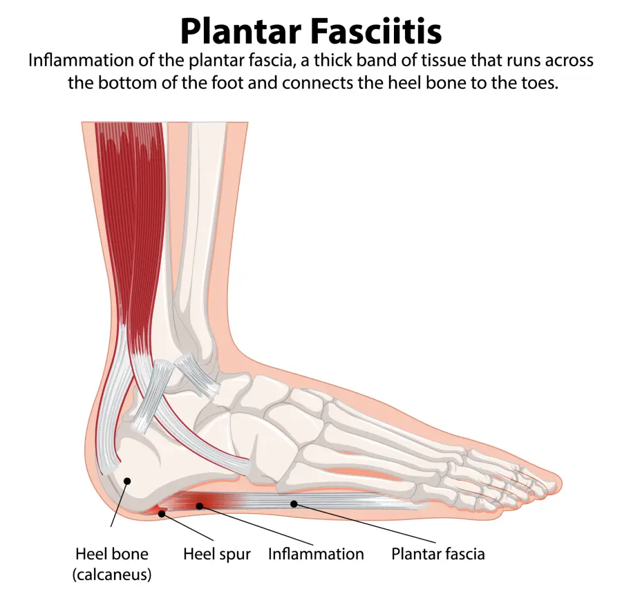 Medical illustration showing plantar fasciitis — inflamed plantar fascia on the underside of the foot, highlighting pain near the heel bone.