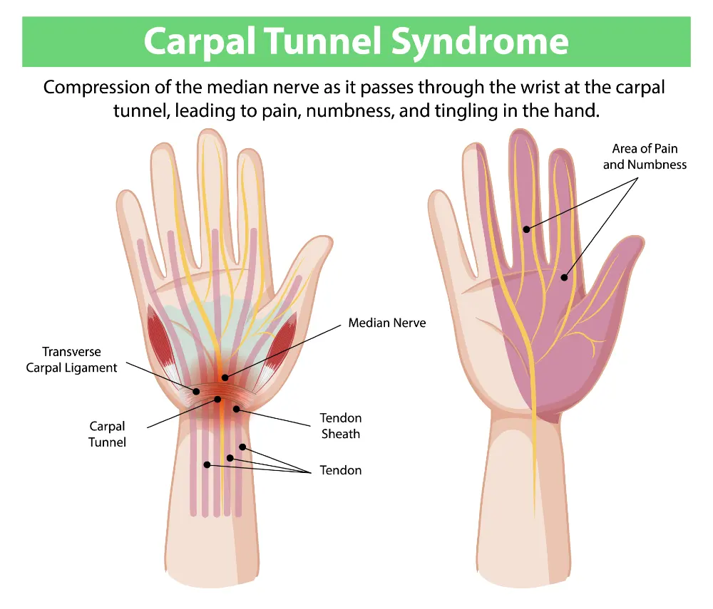 Medical illustration of carpal tunnel syndrome showing compression of the median nerve as it passes through the wrist, causing hand pain and tingling.