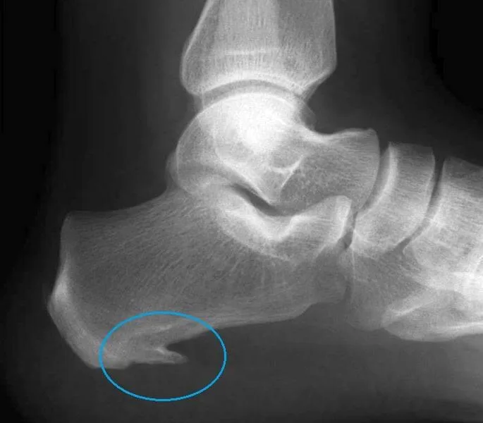 X-ray image showing a heel spur (calcaneal spur) — bony projection extending from the bottom of the heel bone near the plantar fascia attachment.