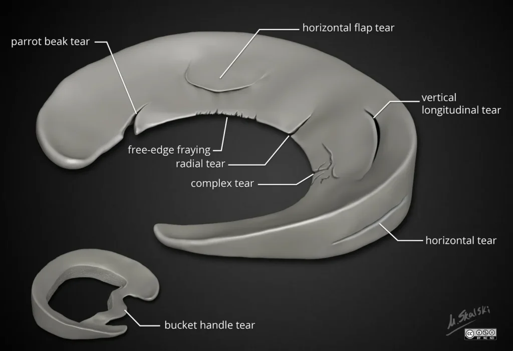 Illustration showing types of meniscus tears in the knee, including vertical, horizontal, radial, and complex tear patterns