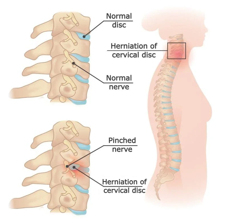 Medical illustration of cervical radiculopathy showing compressed nerve root in the neck due to a herniated disc, causing arm pain and hand tingling.