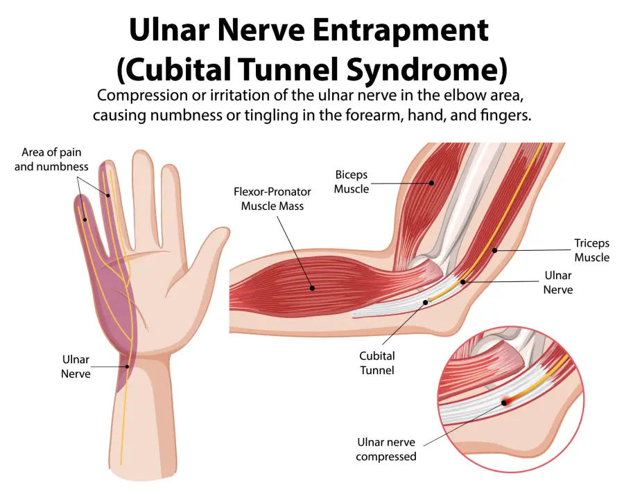 Illustration of ulnar nerve entrapment in cubital tunnel syndrome, showing compression at the elbow and resulting hand tingling and finger numbness.