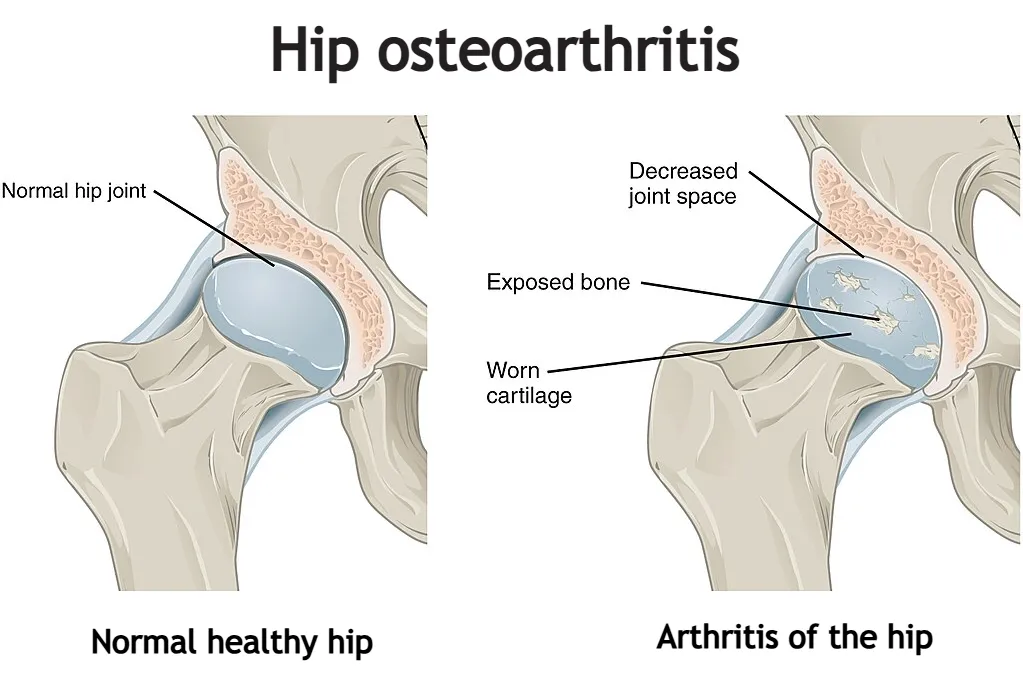 Schematic illustration of hip arthritis – comparison of a healthy hip joint and an arthritic hip joint, showing cartilage damage, joint space narrowing, osteophyte formation, and joint degeneration.