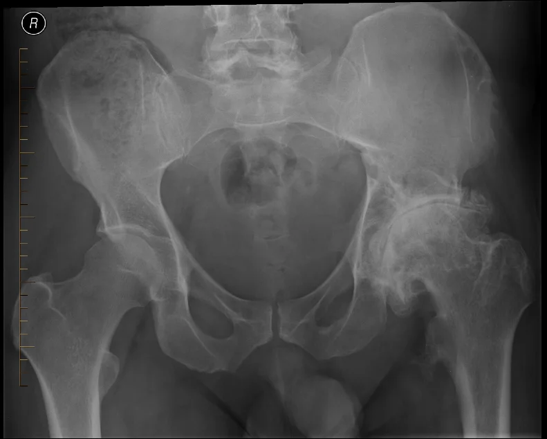 X-ray of the left hip with severe osteoarthritis, displaying significant narrowing of the joint space, formation of osteophytes (bone spurs), and structural changes to the femoral head and acetabulum.