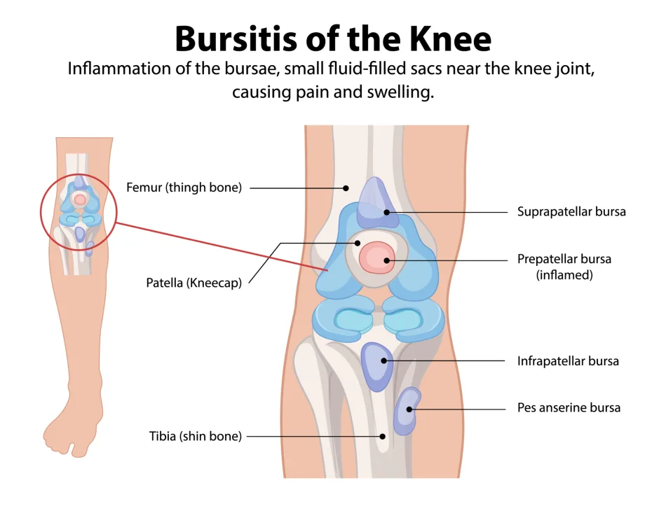 Schematic illustration of the knee showing the bursae around the joint, including the suprapatellar bursa, prepatellar bursa, infrapatellar bursa, pes anserine bursa, and the semimembranosus bursa.