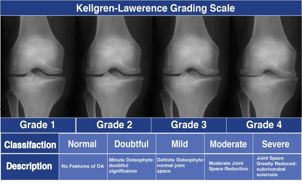Stages of Knee Osteoarthritis According to the Kellgren–Lawrence Classification