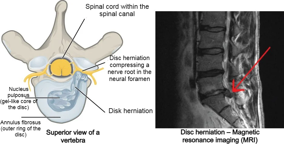 Sciatica caused by lumbar disc herniation with nerve root compression in the neural foramen; left schematic illustration, right MRI image.