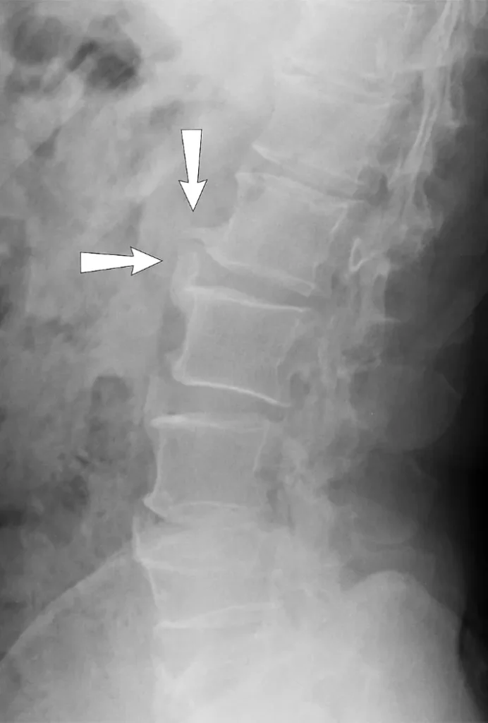 X-ray of the lumbar spine showing lumbar spondylosis with osteophyte formation (bone spurs).