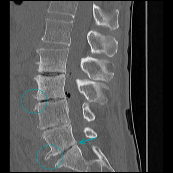 Lumbar spine MRI showing lumbar spondylosis with narrowed intervertebral disc space and osteophyte formation.
