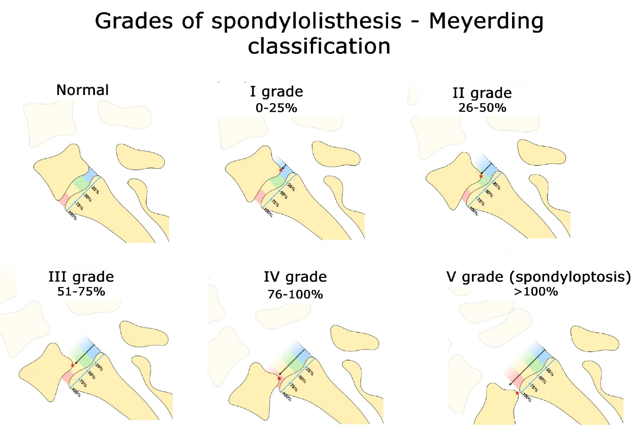 Diagram illustrating the grades of spondylolisthesis according to the Meyerding classification.