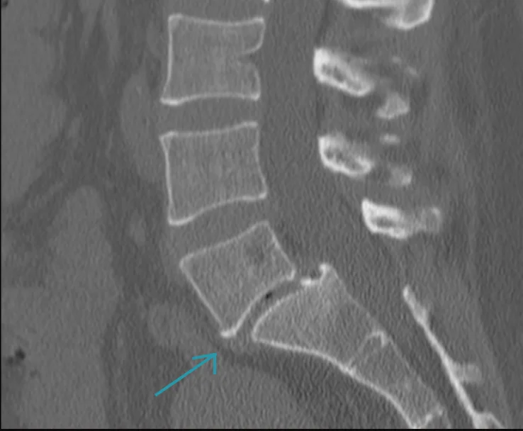CT scan of the lumbosacral spine showing spondylolisthesis at L5–S1 with vertebral slippage
