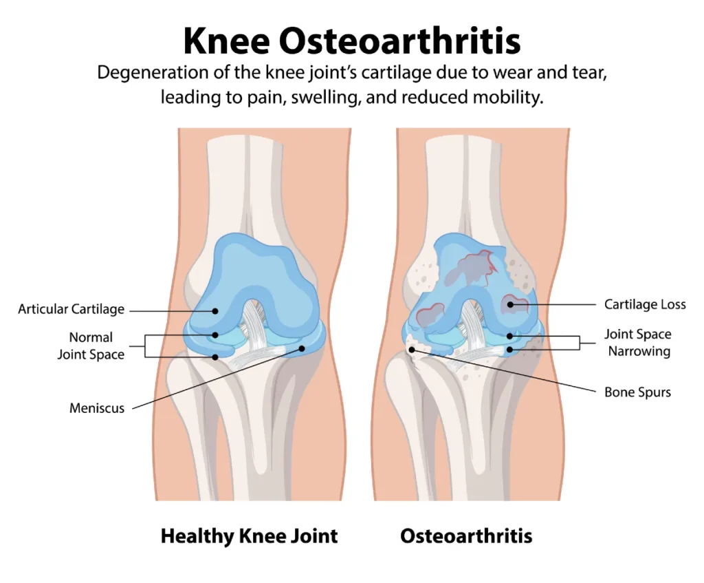 Healthy knee compared to knee with osteoarthritis showing cartilage damage, joint space narrowing, and osteophyte formation