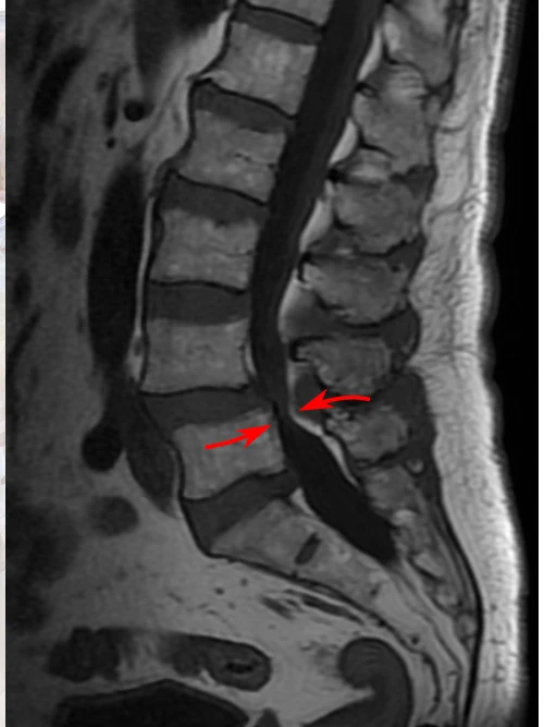 MRI scan of the lumbar spine demonstrating central spinal canal stenosis.