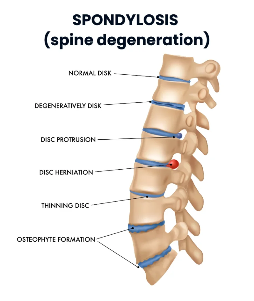 Schematic illustration of spinal spondylosis showing key features: intervertebral disc degeneration, herniated disc, osteophyte formation, facet joint osteoarthritis, and ligament thickening.