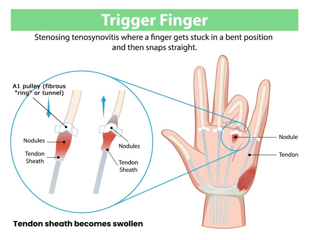 Trigger finger (stenosing tenosynovitis) – schematic illustration: catching of the flexor tendon and development of the characteristic snapping beneath the A1 pulley during finger movement.