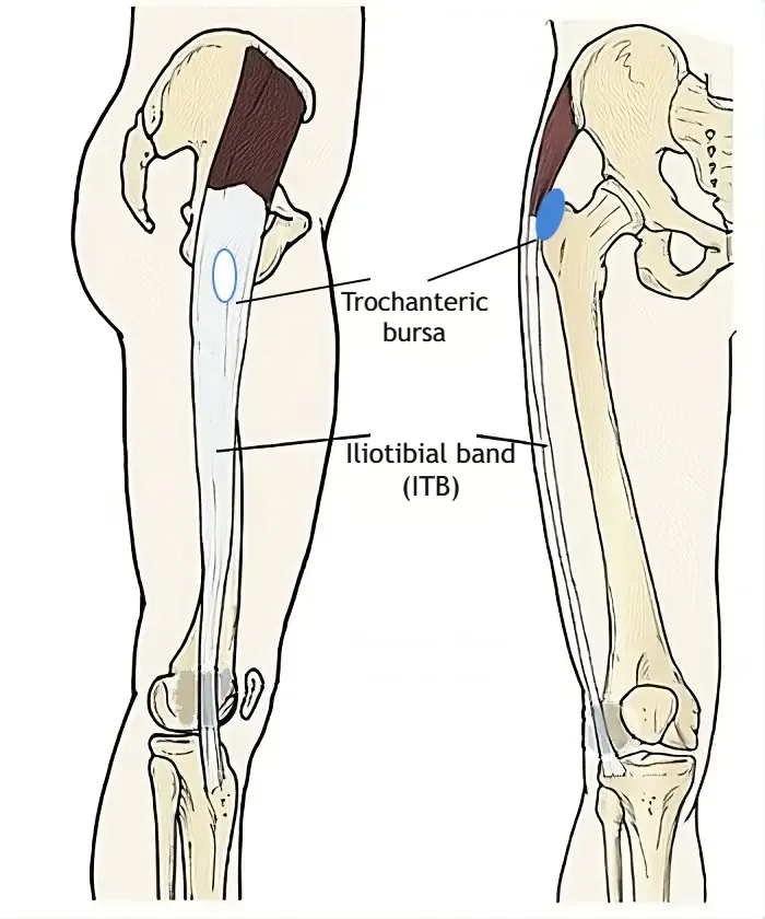 Anatomical illustration of the hip and thigh showing the location of the iliotibial band, greater trochanter of the femur, and the trochanteric bursa.