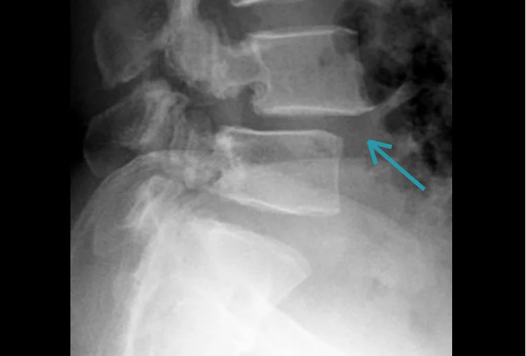 Lumbar spine X-ray showing grade I–II spondylolisthesis at L4–L5 with mild vertebral slippage.