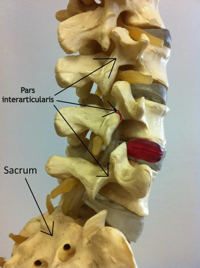 Spondylolysis – anatomical spine model showing a fracture of the vertebra pars interarticularis.