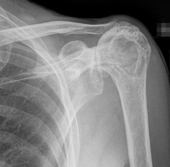 Shoulder X-ray demonstrating cranial migration of the humeral head toward the acromion as a sign of massive rotator cuff tear.