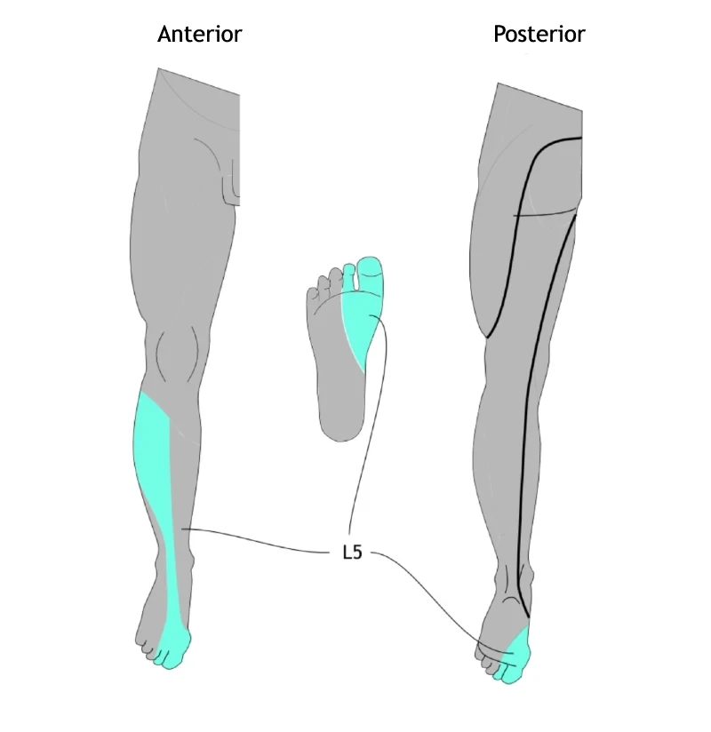Diagram showing dermatomal distribution of tingling and sensory changes in the lower limb related to L5 nerve root compression or injury, including areas of paresthesia in the leg and foot.