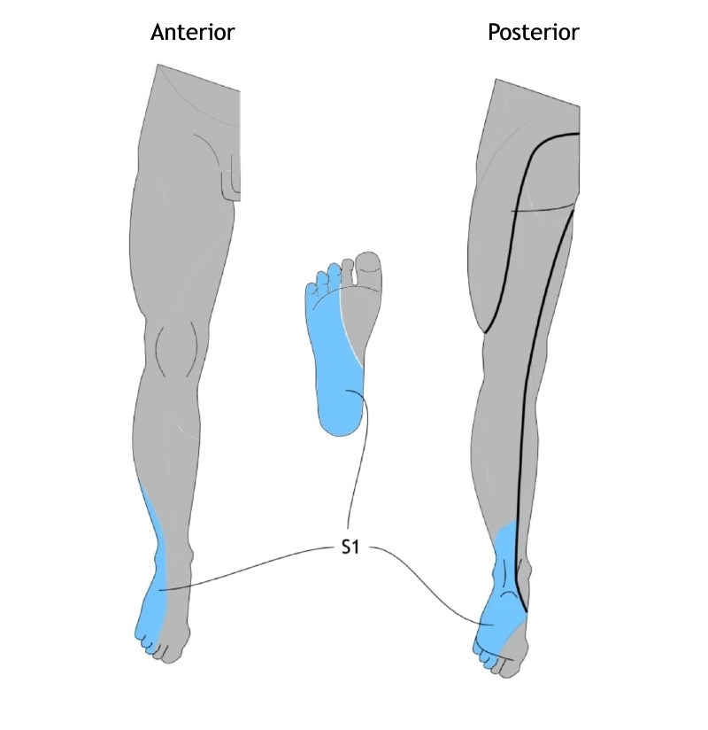 Diagram showing dermatomal distribution of tingling and sensory changes in the lower limb related to S1 nerve root compression or injury, including areas of paresthesia in the leg and foot.