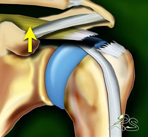 Schematic illustration of a complete full-thickness supraspinatus tendon tear with retraction and fatty muscle atrophy of the rotator cuff.