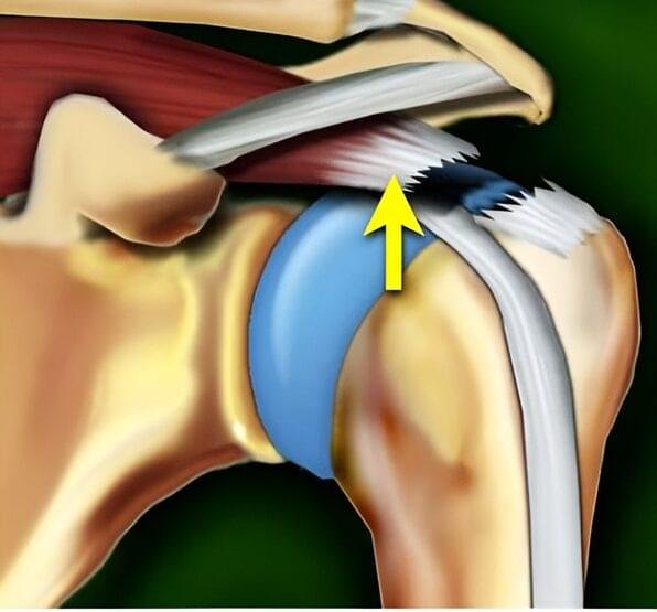 Schematic diagram of a complete full-thickness supraspinatus tendon tear with tendon retraction in the shoulder.