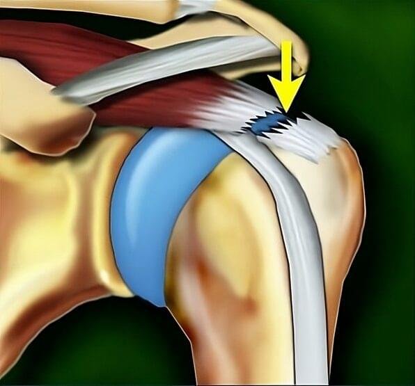 Schematic illustration of a complete full-thickness supraspinatus tendon tear without retraction in the rotator cuff.