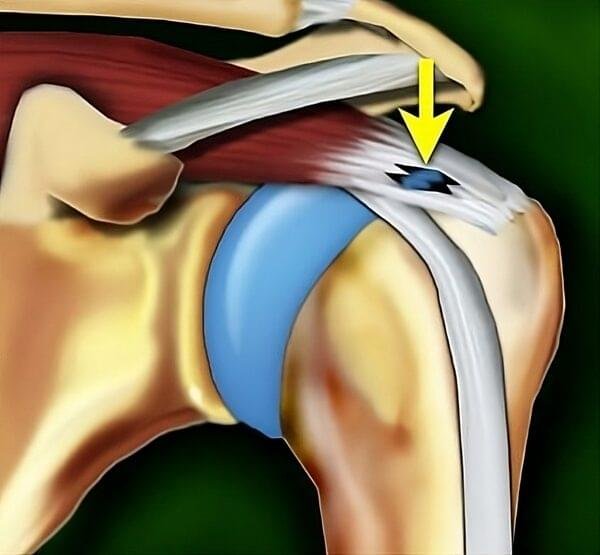 Schematic diagram of an incomplete full-thickness supraspinatus tendon tear in the shoulder rotator cuff.