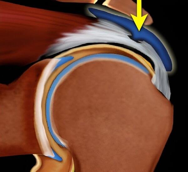 Schematic illustration of a partial bursal-sided supraspinatus tendon tear affecting the outer surface of the rotator cuff.
