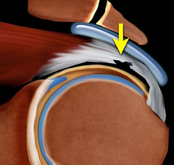 Schematic diagram of a partial articular-sided supraspinatus tendon tear on the joint surface of the shoulder rotator cuff.