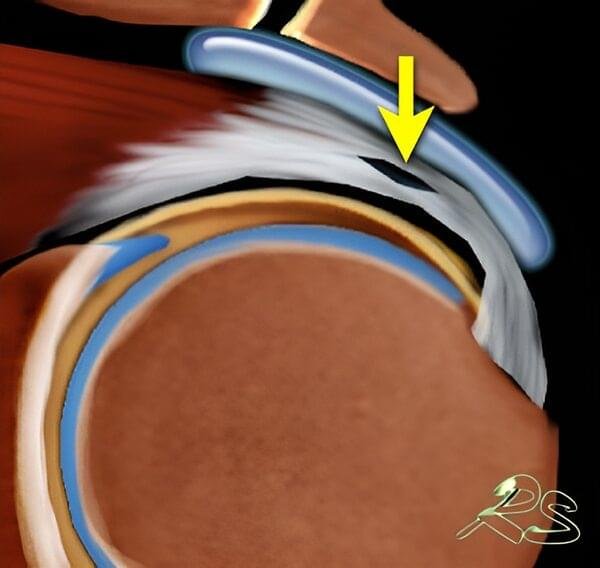 Schematic illustration of a partial intrasubstance supraspinatus tendon tear within the rotator cuff, a common cause of shoulder pain.