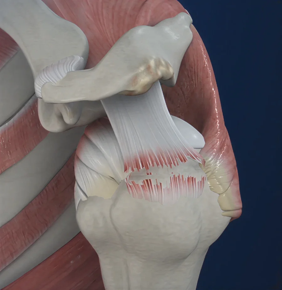 3D model showing a full thickness supraspinatus tendon tear with complete disruption of the supraspinatus tendon in the rotator cuff.
