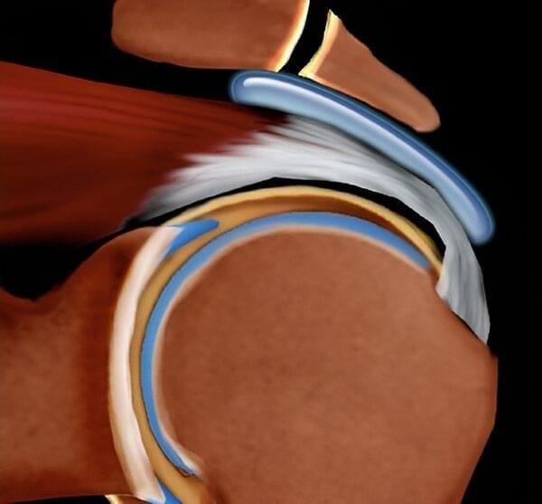 Schematic diagram of a normal supraspinatus tendon with intact rotator cuff structure and normal tendon fibers.