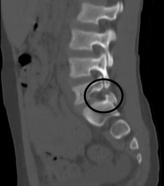 CT scan of the spine showing spondylolysis – bony defect of the vertebral pars interarticularis