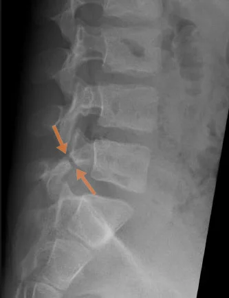 X-ray of the lumbar spine showing spondylolysis – bony defect of the vertebral pars interarticularis
