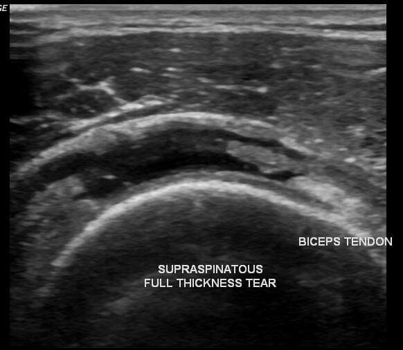Shoulder ultrasound image showing a full-thickness supraspinatus tendon tear in transverse view.