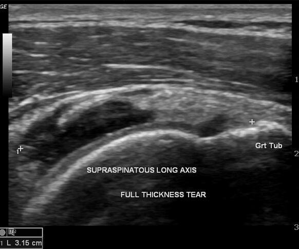 Shoulder ultrasound image of a full-thickness supraspinatus tendon tear in longitudinal view.
