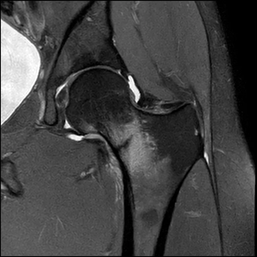 MRI scan showing a femoral neck stress fracture of the hip with visible bone stress injury and inflammation.