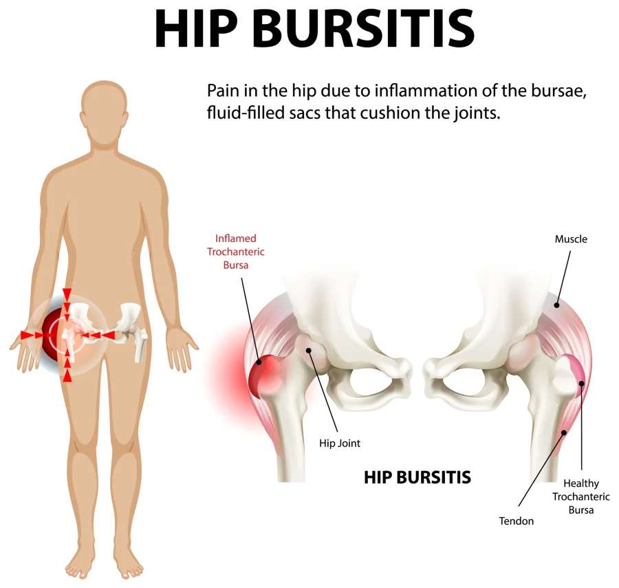 Hip bursitis schematic illustration showing inflamed bursa over the greater trochanter, hip joint anatomy and lateral hip pain location diagram for diagnosis explanation