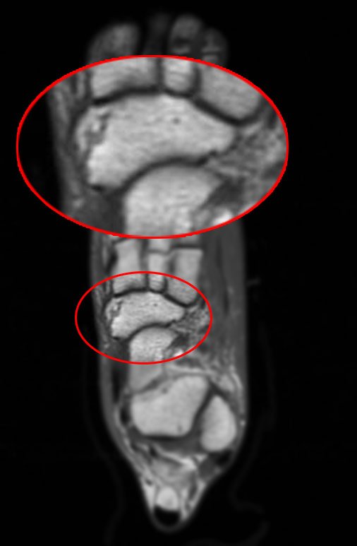 MRI scan showing a hairline (stress) fracture of the navicular bone in the foot.
