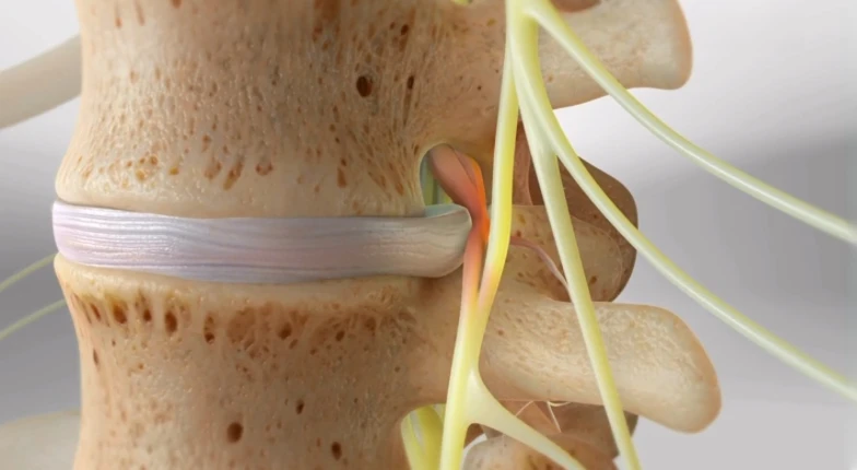 Herniated cervical disc compressing a spinal nerve root causing cervical radiculopathy with radiating arm pain and neurological symptoms.