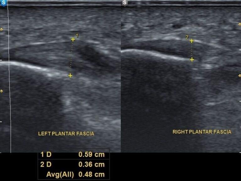 Ultrasound comparison of plantar fascia showing thickened plantar fascia on the left image and normal plantar fascia on the right image.