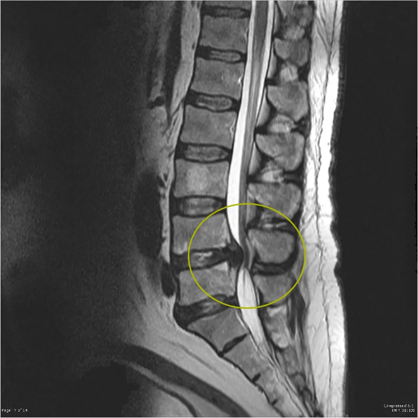 MRI of the lumbar spine showing severe spinal canal stenosis with significant narrowing of the spine and compression of neural structures.