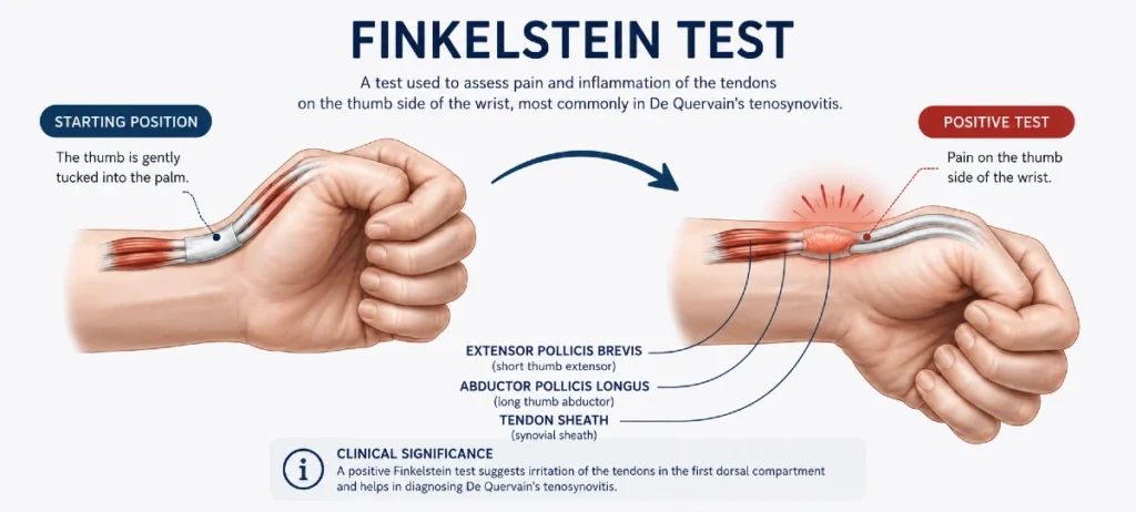 Clinical demonstration of the Finkelstein maneuver for diagnosing De Quervain tenosynovitis, showing the patient’s thumb flexed into the palm with ulnar deviation of the wrist, reproducing pain over the first dorsal compartment tendons (abductor pollicis longus and extensor pollicis brevis).