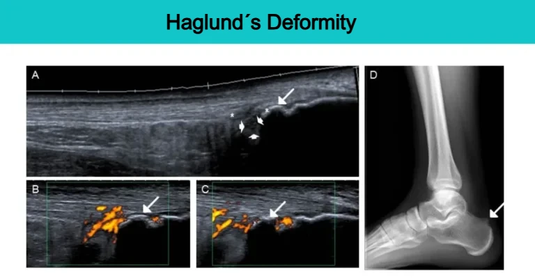 Ultrasound and X‑ray images showing Haglund’s deformity with a prominent calcaneal spur, Achilles tendon degeneration with neovascularization, and retrocalcaneal bursitis.